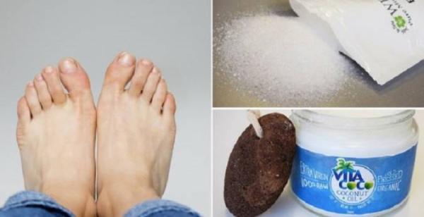 درمان پینه دست و پا با استفاده از سنگ پا و پماد های آنتی بیوتیک