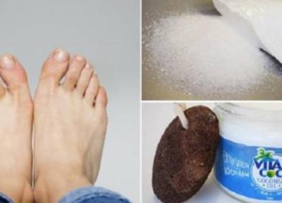 درمان پینه دست و پا با استفاده از سنگ پا و پماد های آنتی بیوتیک